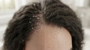 Healthy scalp results using dandruff shampoo bar